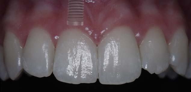 Dentale Implantate Bremen in der Implantologie