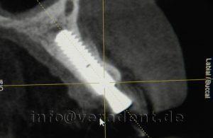 Detailaufnahme Röntgenbild bei Implantatbehandlung